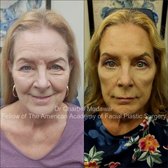 blepharoplasty browlift upper and lower fat pad removal drcharbel medawar facial plastic surgeon style beauty clinic beirut lebanon 5