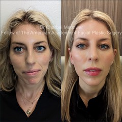 facial beautification makeover plastic surgery rhinoplasty blepharoplasty browlift botox fillers lip fillers chin jawline cosmetic aesthetic procedures front view