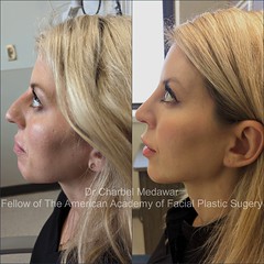 facial beautification makeover plastic surgery rhinoplasty blepharoplasty browlift botox fillers lip fillers chin jawline cosmetic aesthetic procedures left profile view