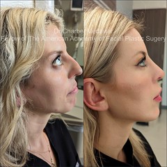 facial beautification makeover plastic surgery rhinoplasty blepharoplasty browlift botox fillers lip fillers chin jawline cosmetic aesthetic procedures right profile view