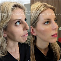 facial beautification makeover plastic surgery rhinoplasty blepharoplasty browlift botox fillers lip fillers chin jawline cosmetic aesthetic procedures right three quarter view