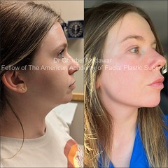 jawline chin filler contouring plastic surgery beirut lebanon style dental clinic 2