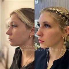 lip fillers botox beirut lebanon plastic surgery style beauty clinic dr charbel medawar 4
