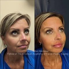 liquid facelift cheek lift jawline contouring fillers botox dr charbel medawar plastic surgery beirut lebanon style beauty clinic 1