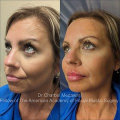 liquid facelift cheek lift jawline contouring fillers botox dr charbel medawar plastic surgery beirut lebanon style beauty clinic 4