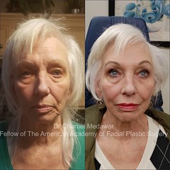liquid facelift cheek lip fillers young anti aging wrinkles dr charbel medawar plastic surgery beirut lebanon style beauty clinic 1