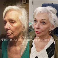 liquid facelift cheek lip fillers young anti aging wrinkles dr charbel medawar plastic surgery beirut lebanon style beauty clinic 3