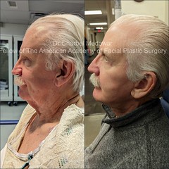 surgical facelift facial rejuvenation dr charbel medawar plastic surgery beirut lebanon style beauty clinic 2