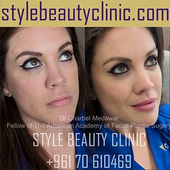 liquid facelift cheek lift jawline contouring lip fillers botox dr charbel medawar plastic surgery beirut lebanon style beauty clinic