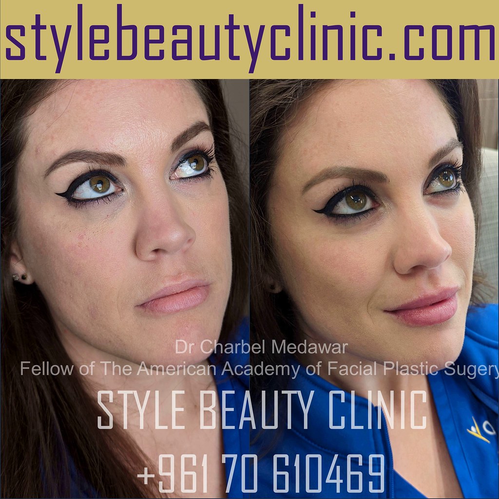 Liquid Facelift Cheek Lift Jawline Contouring Lip Fillers Botox Dr 