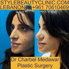 Nose Plastic Surgery in Lebanon