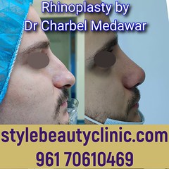 best nosejob plastic surgeon in lebanon dr charbel medawar