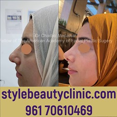 best rhinoplasty lebanon