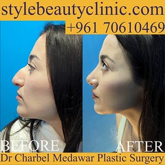 best rhinoplasty surgeon in lebanon