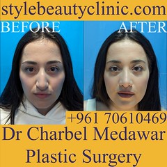 best rhinoplasty surgeron lebanon