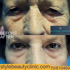 Blepharoplasty Lebanon