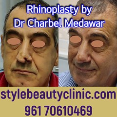 dr charbel medawar reconstructive nose surgery lebanon