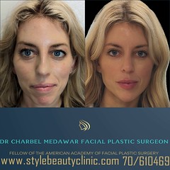 heidi bitton jawline transformation by dr charbel medawar