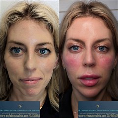 heidi bitton lip filler by dr charbel medawar