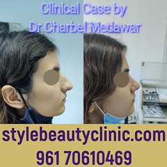 rhinoplasty