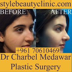 rhinoplasty price in lebanon